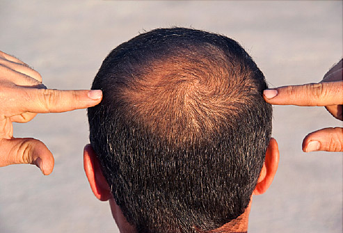 baldness treatment